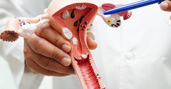 Cervical Cancer in pictures