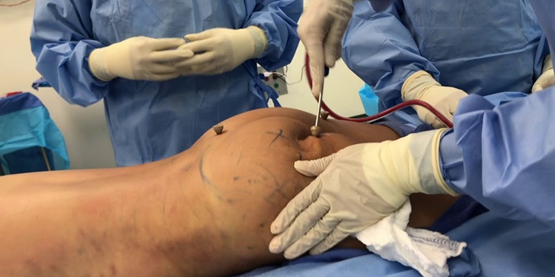 Brazilian Butt Lift—BBL surgery