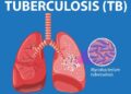 Tuberculosis
