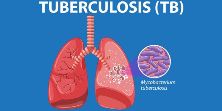 Tuberculosis