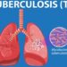 Tuberculosis